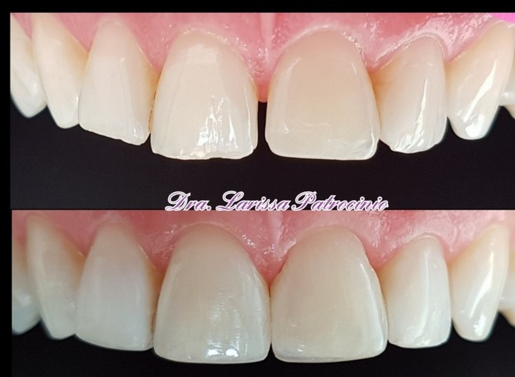 Fechamento de diastemas