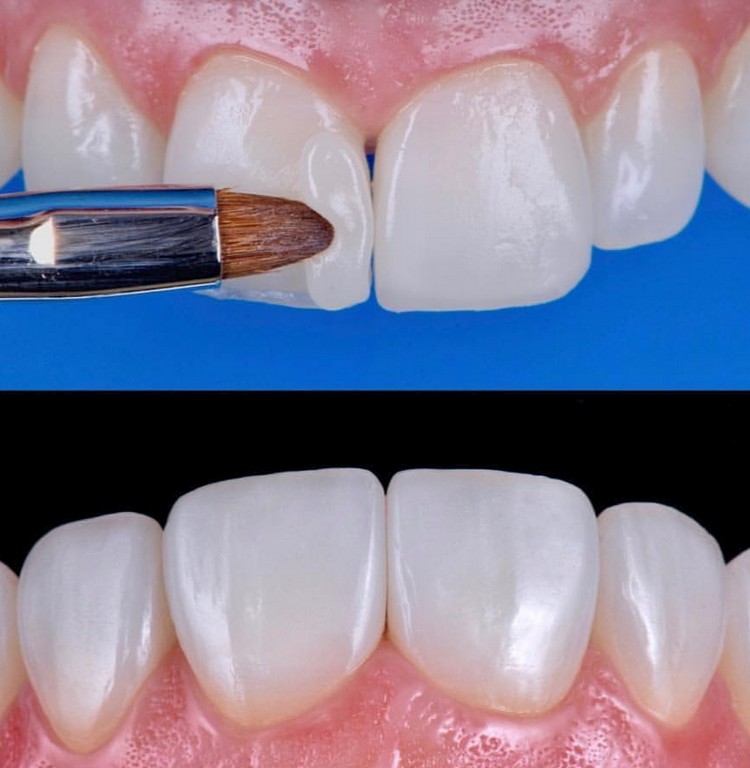 Resina Composta: O material mais versátil da Odontologia