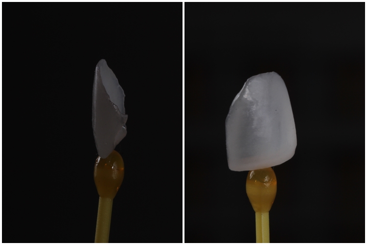 Nas facetas de cerâmica, percebe-se menor translucidez e maior espessura da peça 