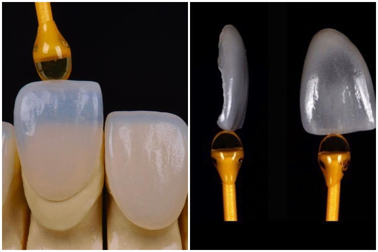 Laminados Cerâmicos, uma grande evolução no tratamento estético odontológico